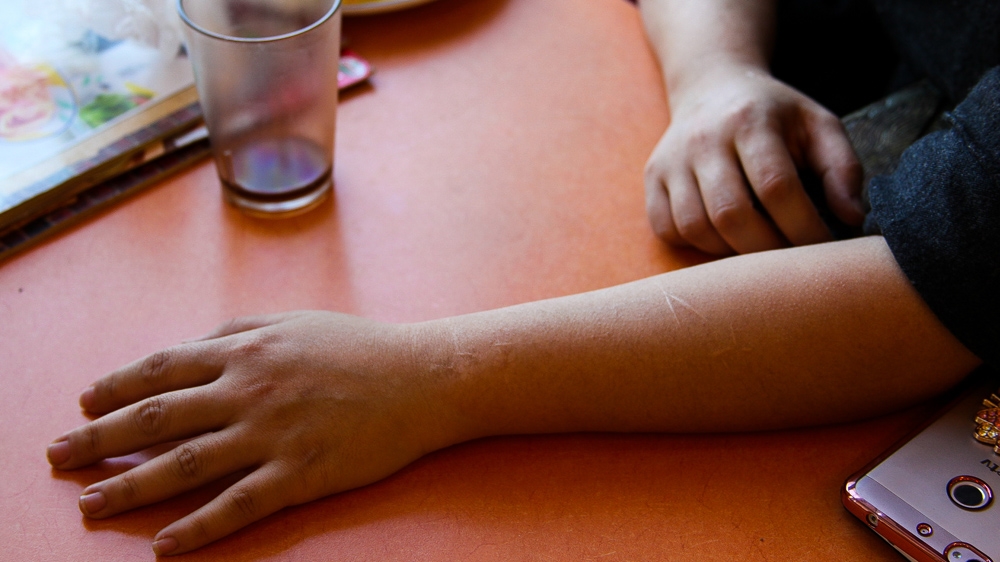 Shirley's arms bear the scars of heroin injections [Allison Griner/Al Jazeera]