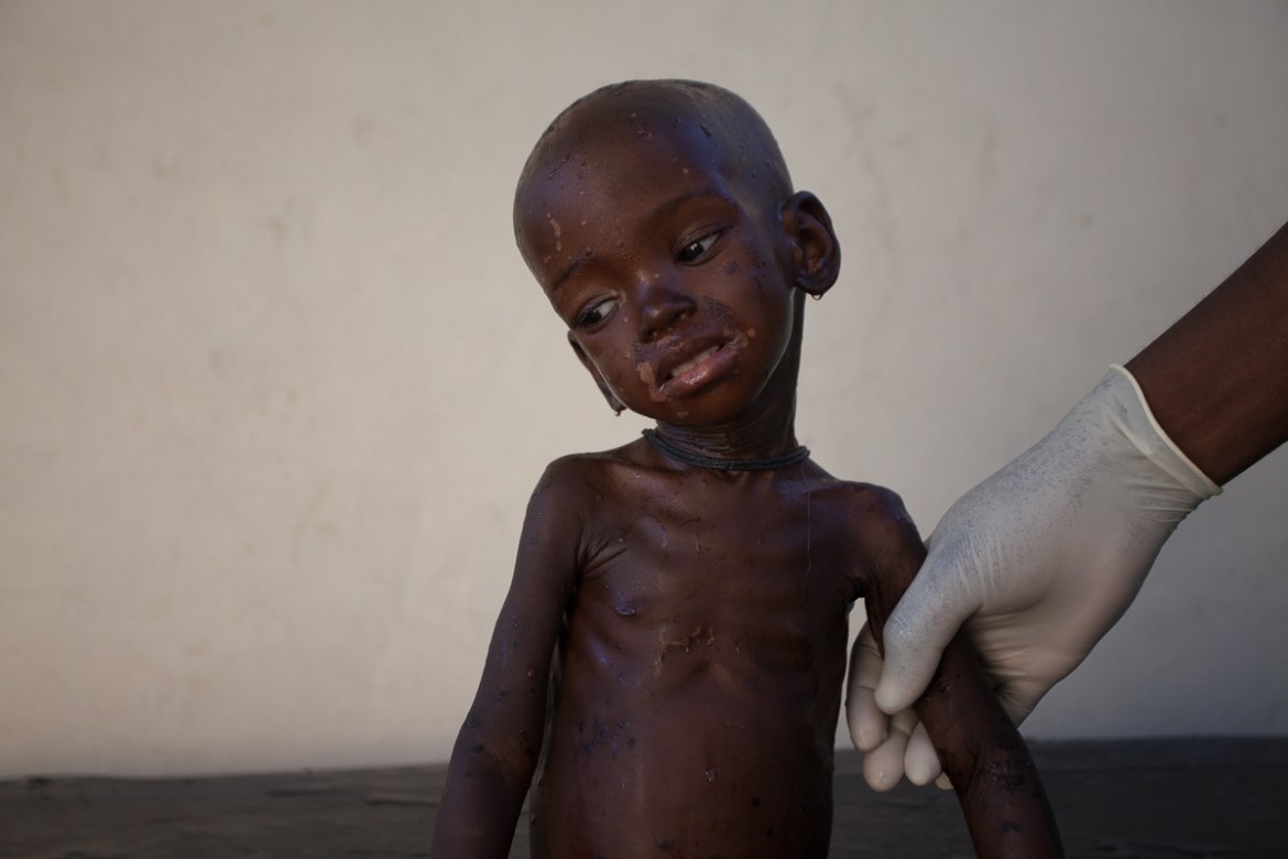 Zara Ibrahim, 20 months old, is washed with Chlorexidine. His skin peels as a result from Kwashiorkor sickness. Four months ago, when his mother was pregnant from another baby, he fell ill. The mother