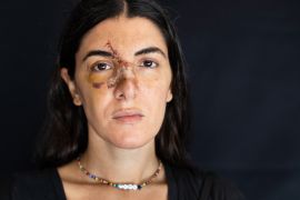 Angelique Sabounjian, who was injured at her office during the Aug. 4 explosion that killed more than 170 people, injured thousands and caused widespread destruction, poses for a photograph in Beirut,