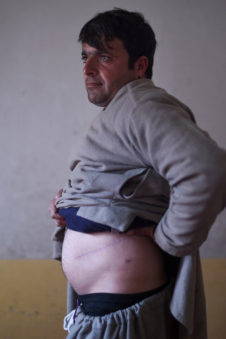 Nooruddin, who sold his kidney to raise money for his family, shows the scars from the operation at his house in the Khwaja Koza Gar area in Herat [Rouba El Husseini/AFP]