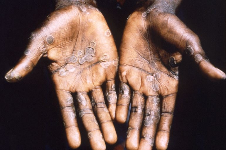 The palms of a monkeypox case patient from Lodja, a city located within the Katako-Kombe Health Zone,