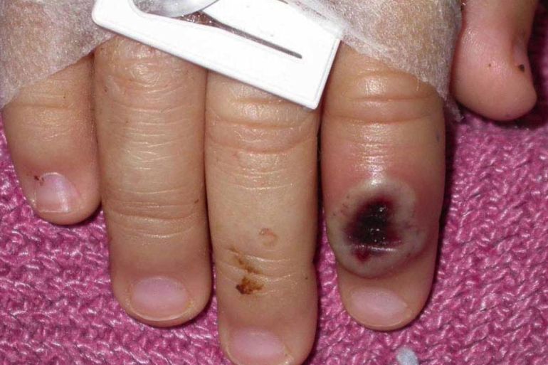 A monkeypox blister on the finger of a patient in hospital with the disease