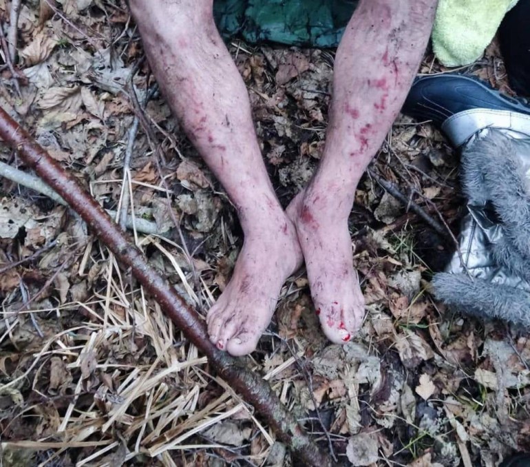 A photo of someone's legs with bruises.