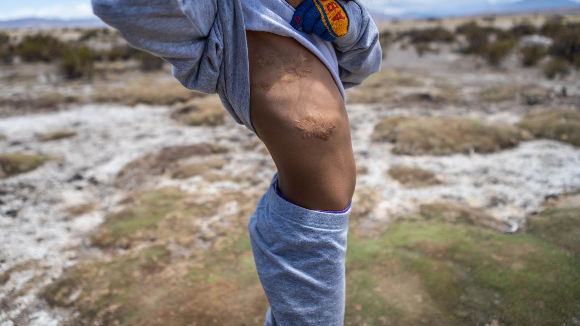 A young girl lifts her grey sweatshirt to reveal knots of scar tissue where her lung surgery took place.