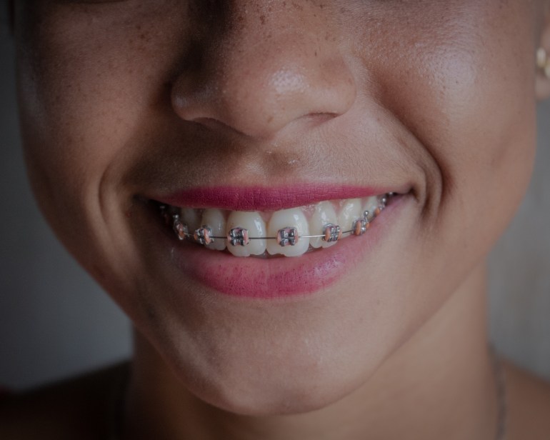 A photo of Manuela with braces on her teeth.