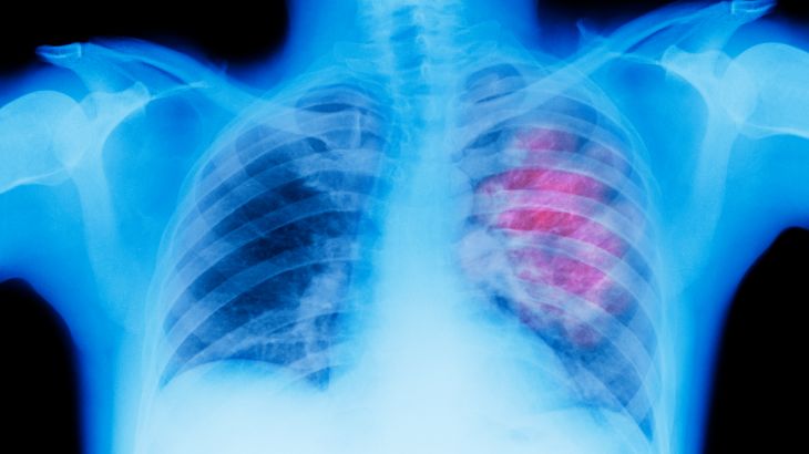 X-ray of lung showing chest cancer