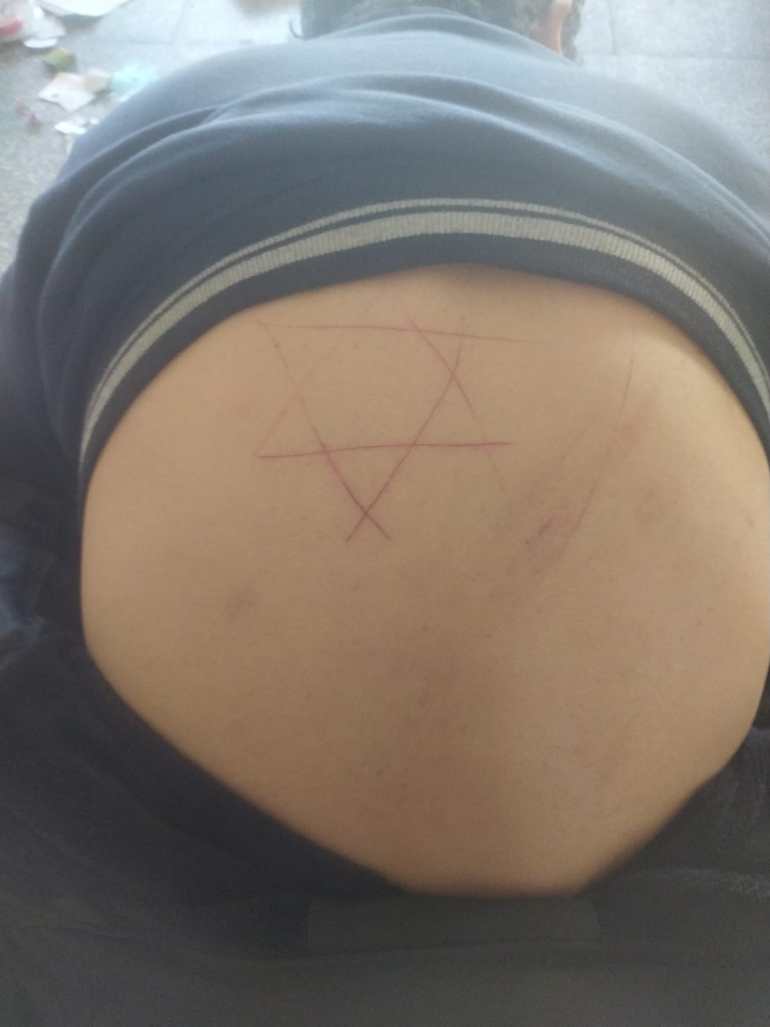 A photo of a Palestinian man's back with the star of David cut into his back with a knife by an Israeli soldier