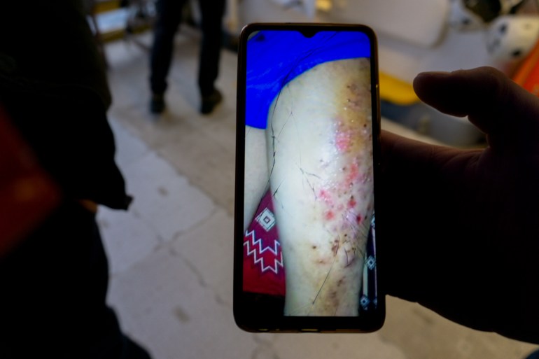 A phone showing a the leg of a young girl with scabies