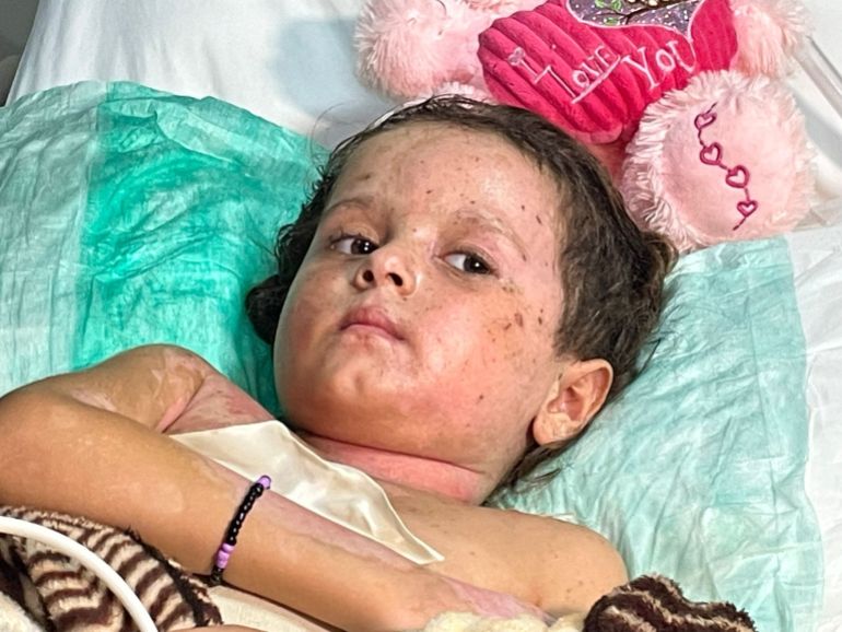 4-year-old Merve, who has serious burns on her body due to the phosphorus bomb